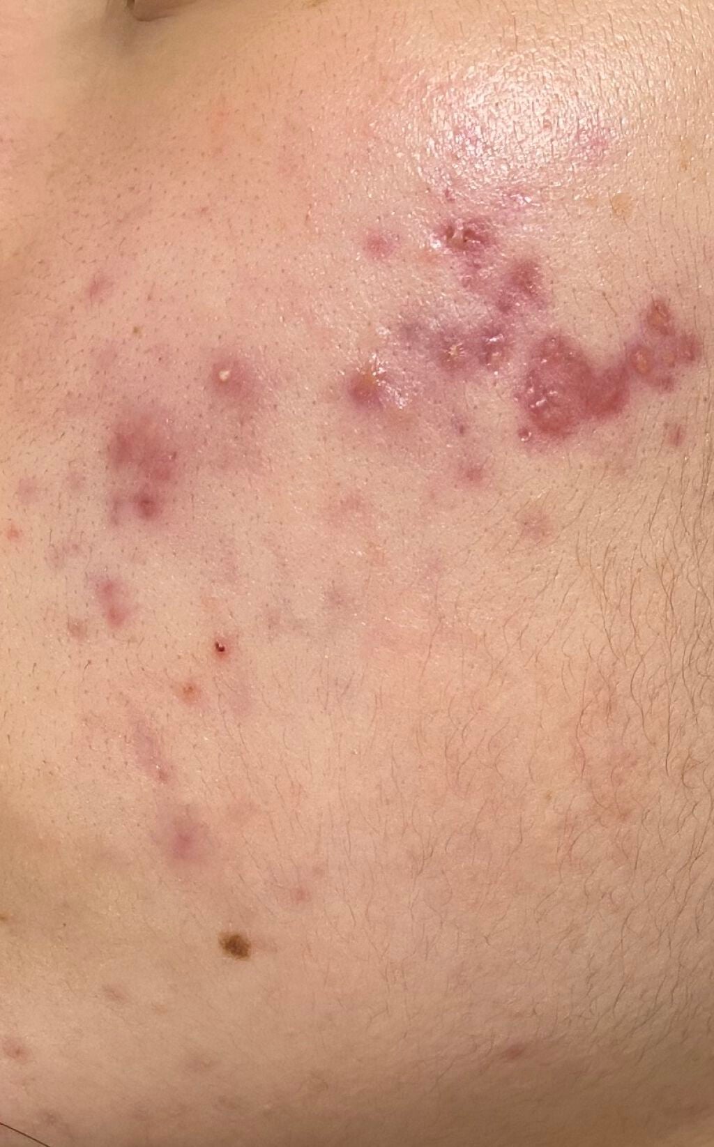 パル on LIPS 「初投稿ですニキビがひどくて困ってます😭高2の夏頃からどんどんど..」(1枚目)