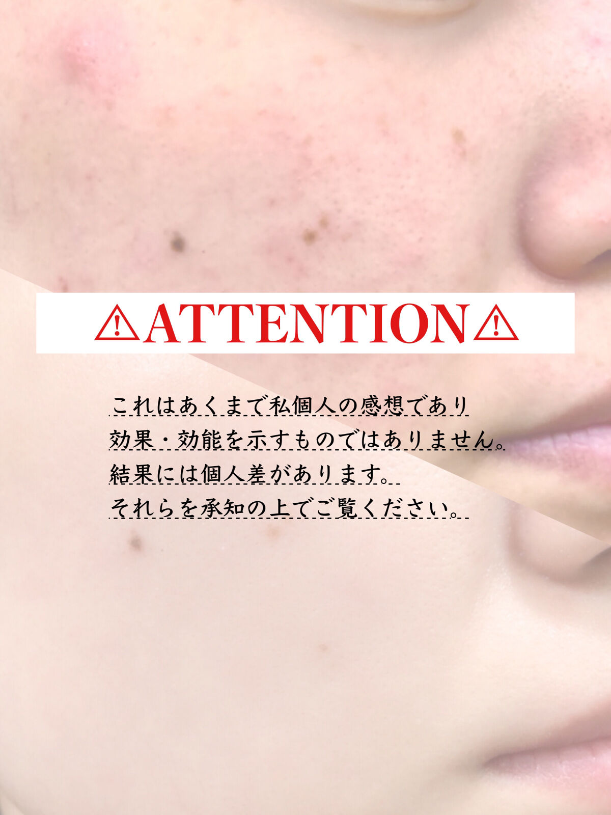 アロフローラ アクネケア エマルジョン L/ハウス オブ ローゼ/乳液を使ったクチコミ（2枚目）