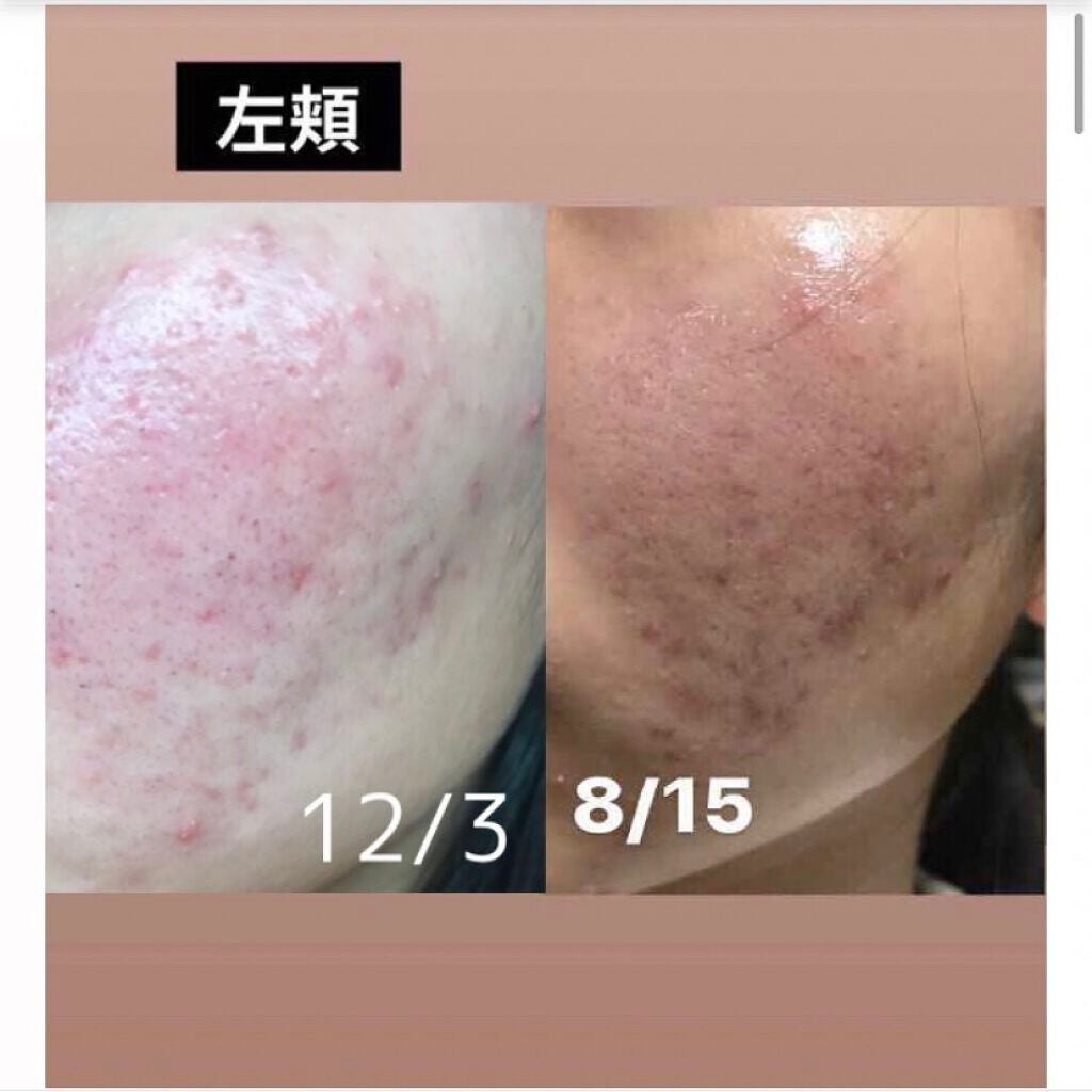 ぽむ on LIPS 「前回の投稿(12/3)から半年後!地道な戦いです。。赤みはまだ..」(5枚目)