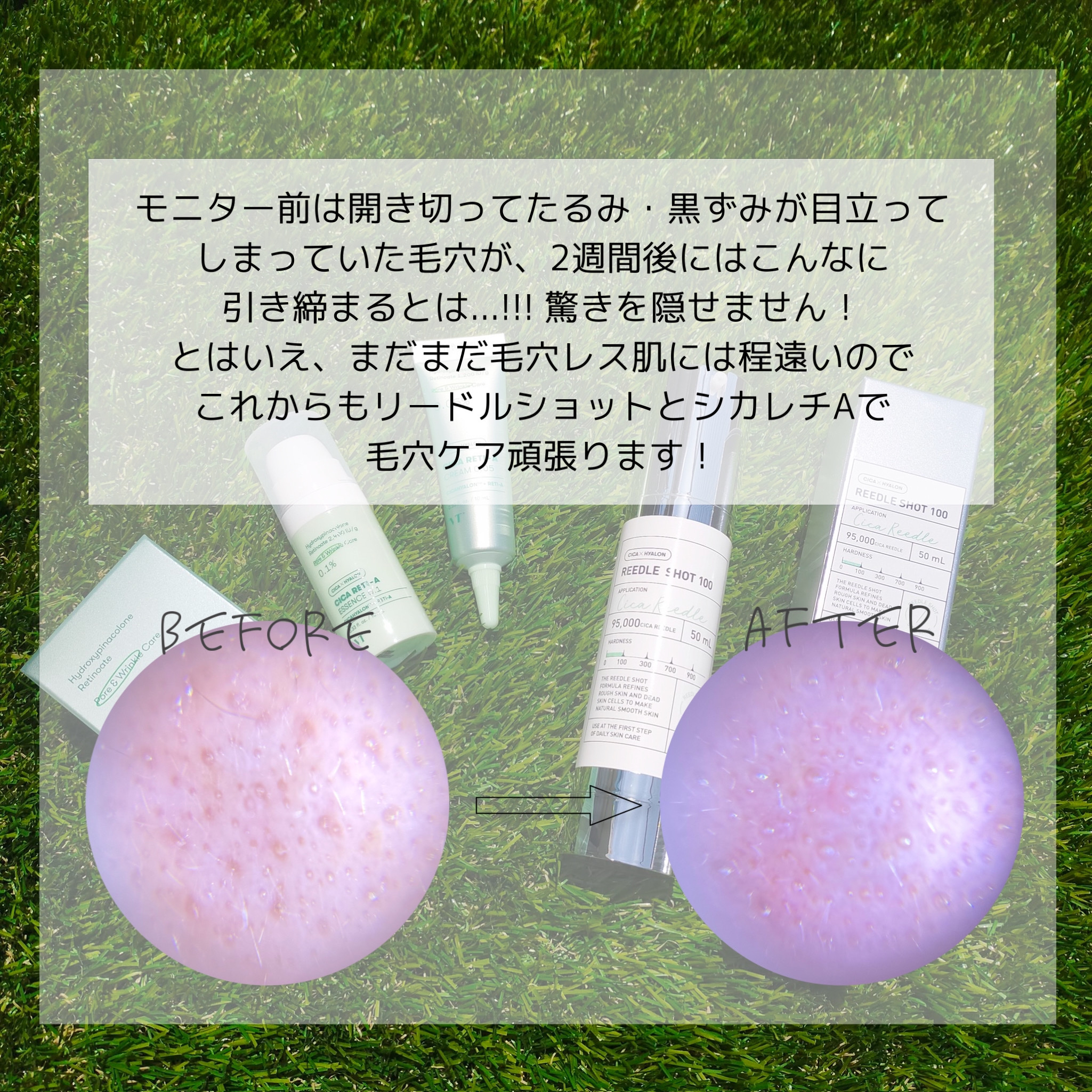 シカレチA クリーム0.05/VT/フェイスクリームを使ったクチコミ（3枚目）