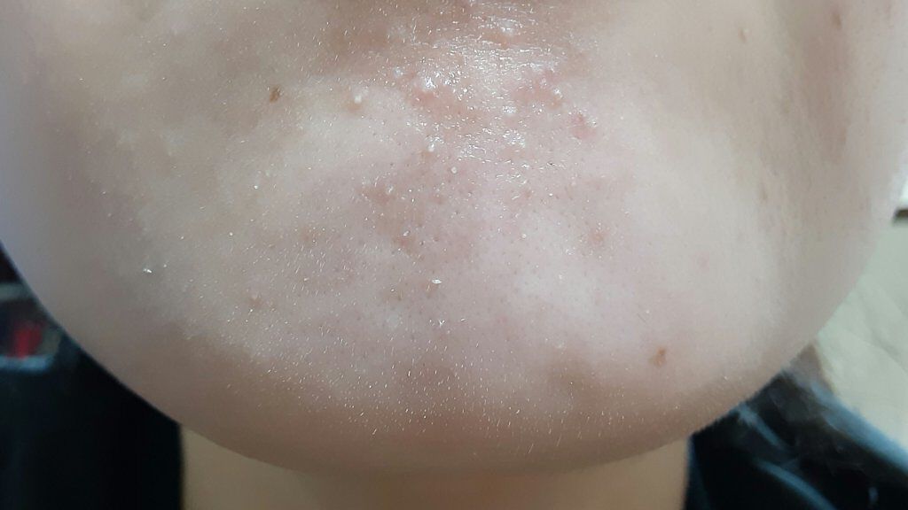 オードムーゲ トライアルセット/オードムーゲ/トライアルキットを使ったクチコミ（2枚目）