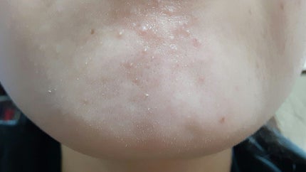 ペアアクネクリームW(医薬品)/ペア/その他を使ったクチコミ(2枚目)