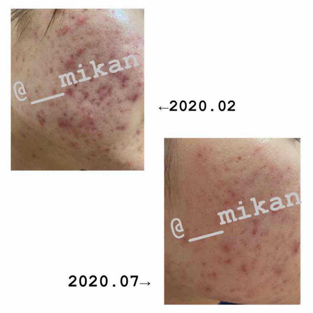 モイスチャークリーム2/エンビロン/フェイスクリームを使ったクチコミ(2枚目)