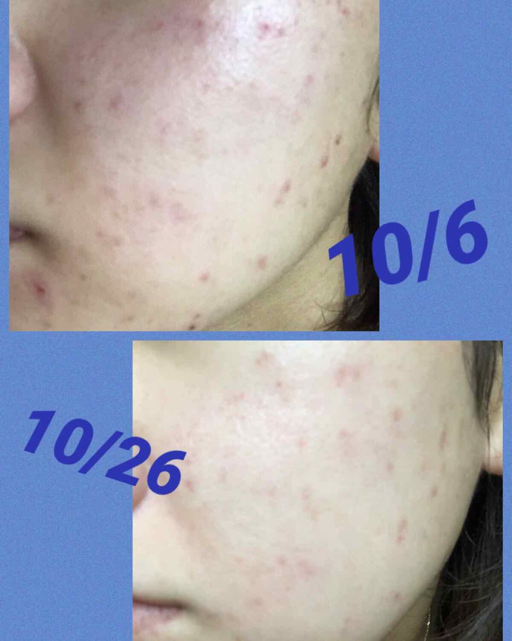 たけだ※たまに投稿 on LIPS 「⚠️肌の写真載せてます⚠️気をつけてみてください🙇♀️写真は..」(2枚目)