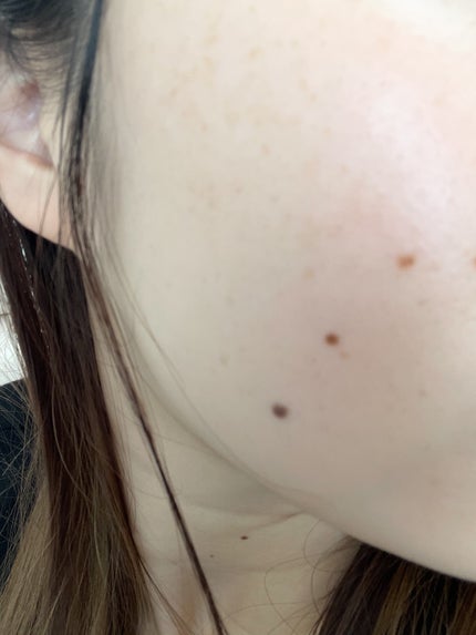 マイルドリードルショット50/VT/美容液を使ったクチコミ(5枚目)