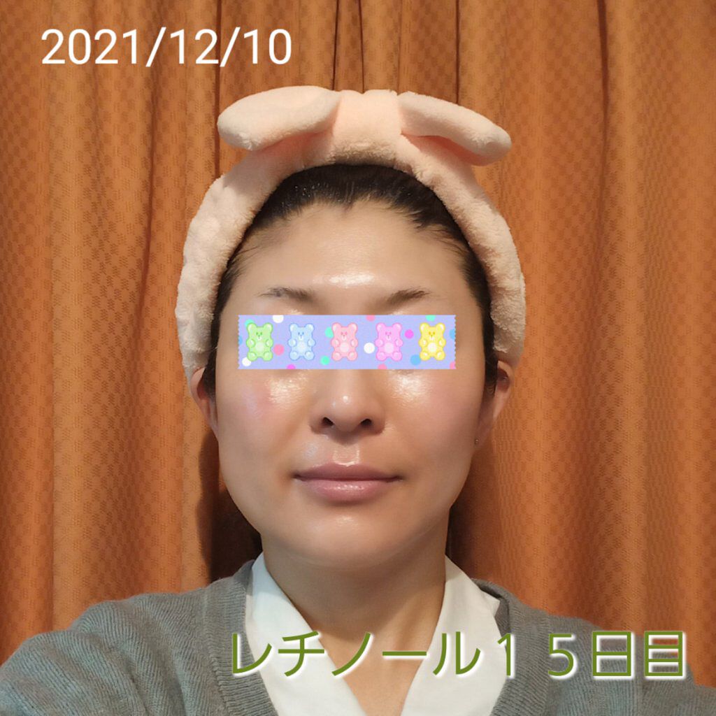 トレチノインジェル/A-Ret/美容液を使ったクチコミ（1枚目）