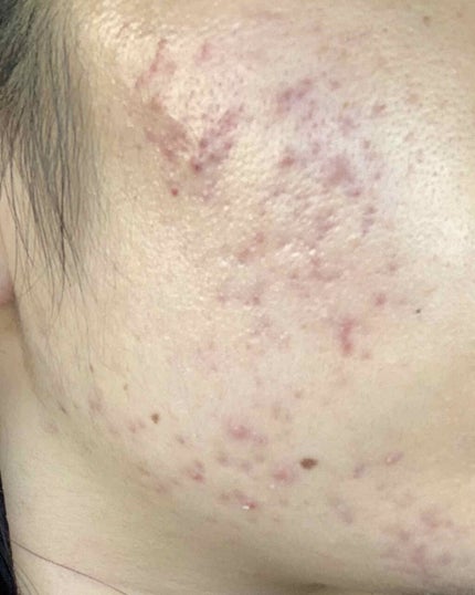 ロゼット洗顔パスタ アクネクリア/ロゼット/洗顔フォームを使ったクチコミ(4枚目)