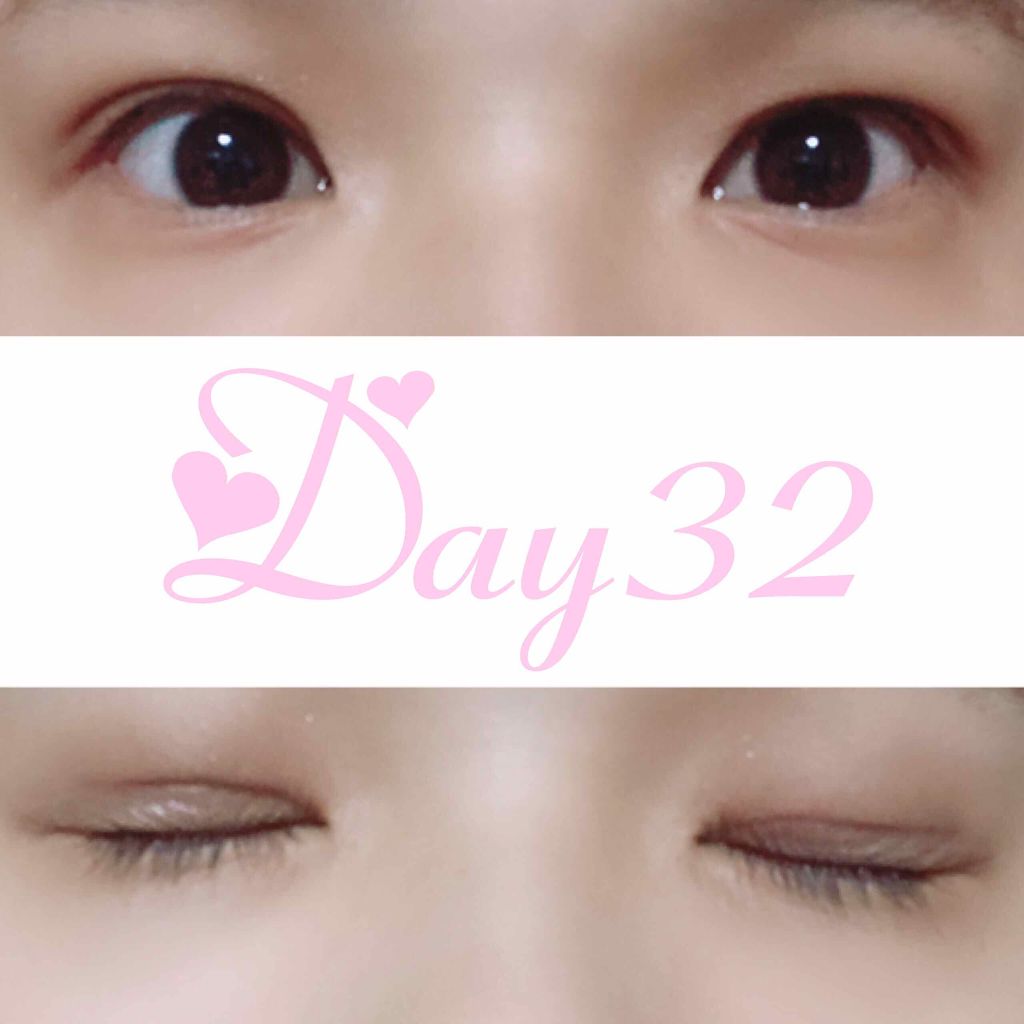 二重整形/その他を使ったクチコミ（2枚目）