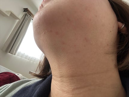 ビタライト リードルショット100/VT/ブースター・導入液を使ったクチコミ(2枚目)