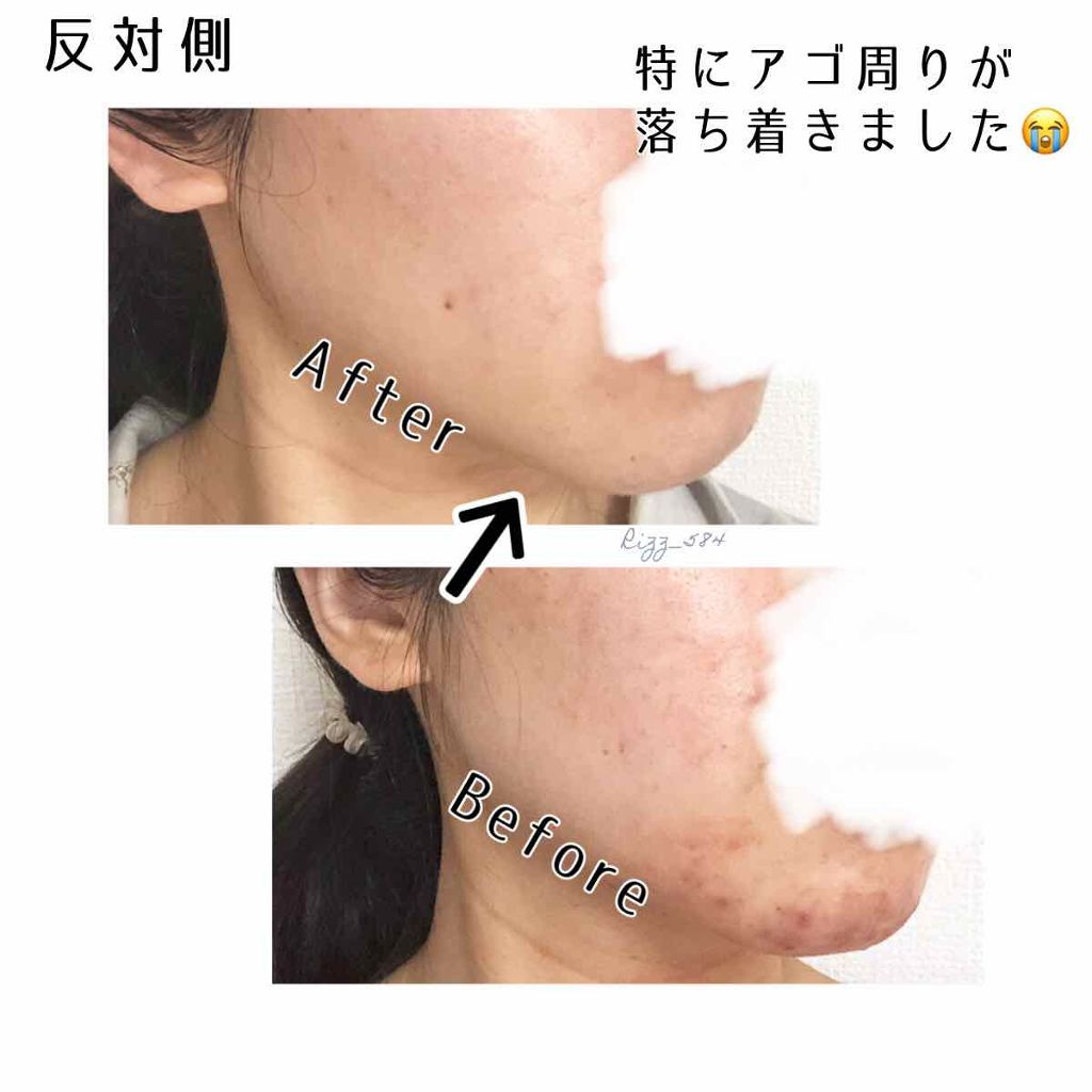 A アクネジェル/NOV/美容液を使ったクチコミ(2枚目)