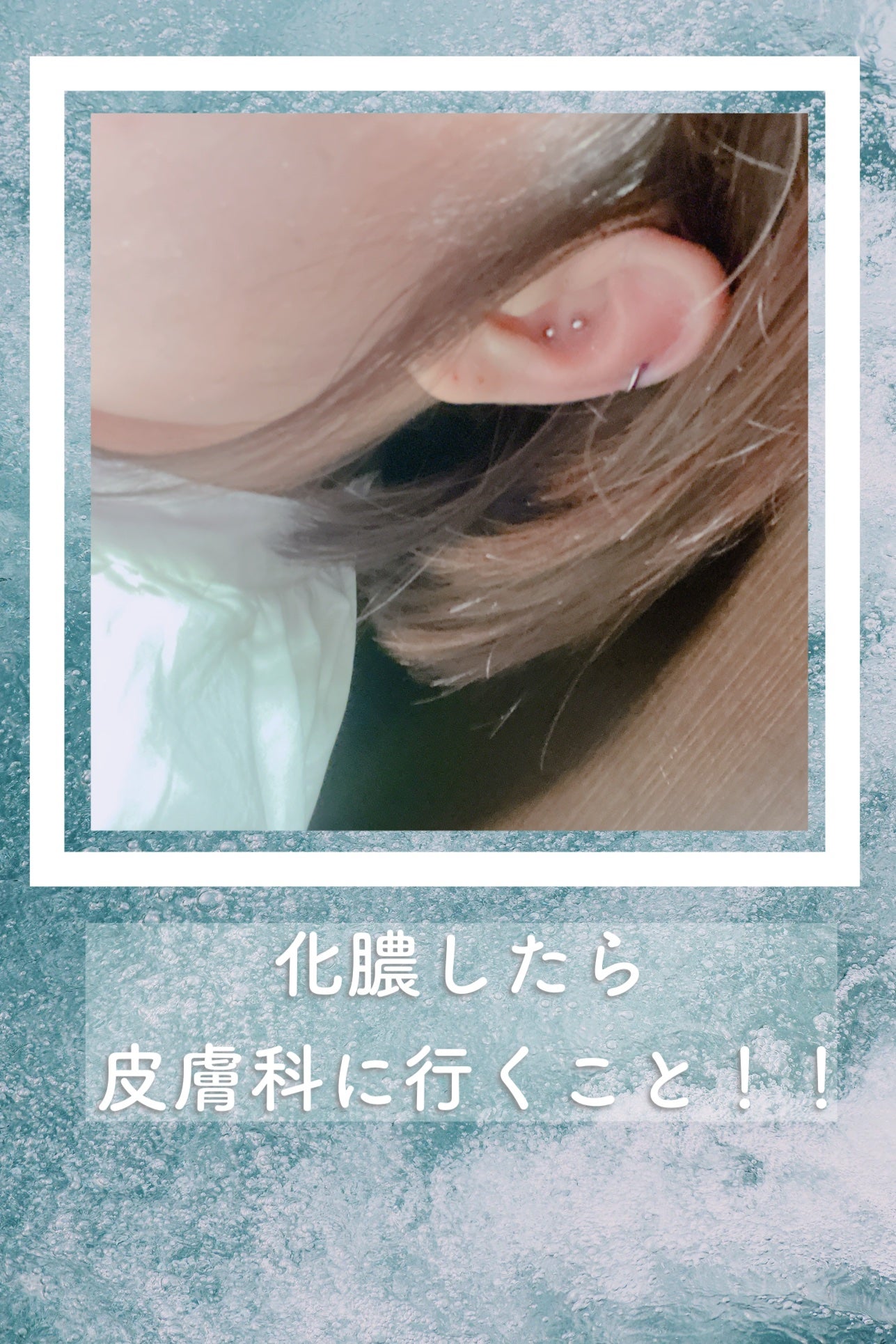 オロナインH軟膏 (医薬品)/オロナイン/その他を使ったクチコミ(3枚目)