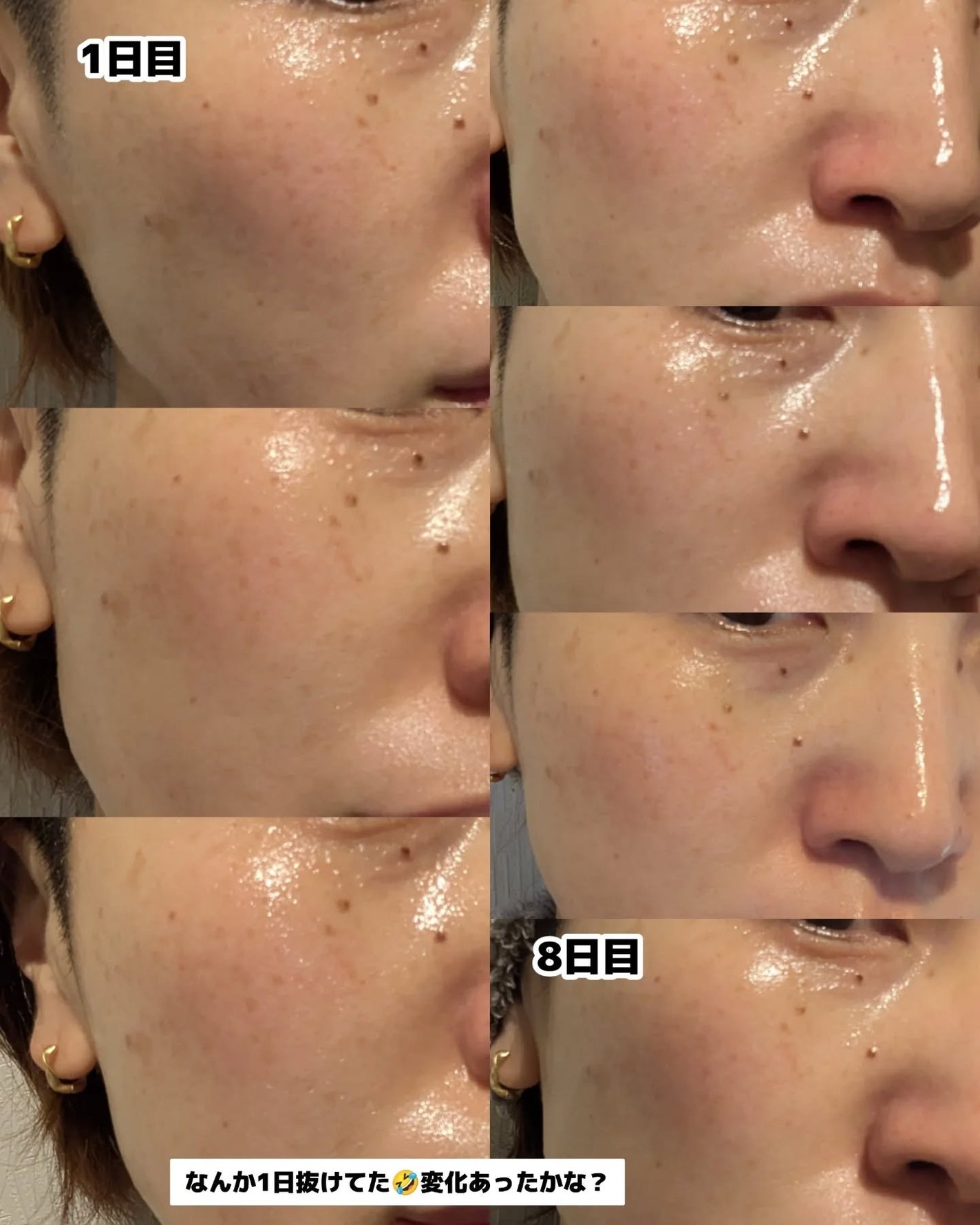 8デイズピュアビタミンCアンプル/VARI:HOPE/美容液を使ったクチコミ(3枚目)