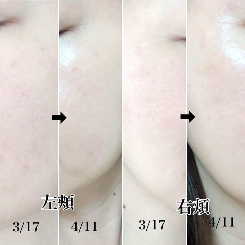 エンリッチCセラム/IGA LAB/美容液を使ったクチコミ(3枚目)