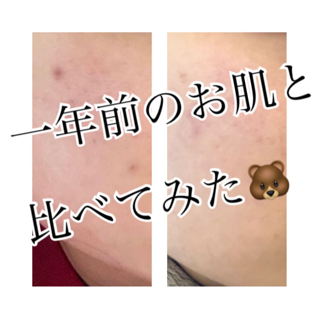 Mone on LIPS 「ちょうどリップスを始めたのが去年の春🌸だったので、当時のお肌と..」(2枚目)