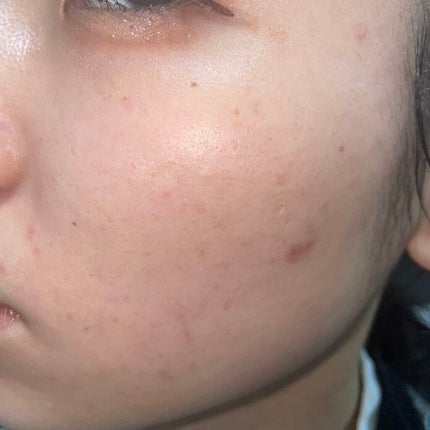 薬用しみ集中対策 プレミアム美容液/メラノCC/美容液を使ったクチコミ(2枚目)