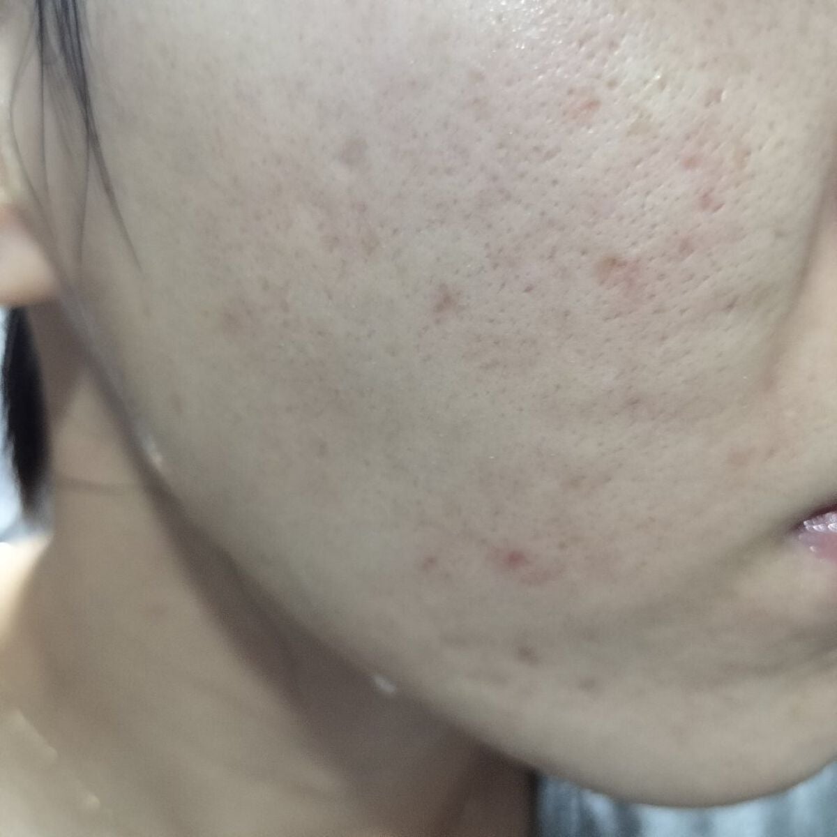 miina@汚肌工事録⚠️ on LIPS 「10/17の#汚肌工事録ありがとう❤/なんとなく赤み見える。ス..」(1枚目)