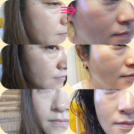 リードルショット100/VT/美容液を使ったクチコミ(9枚目)