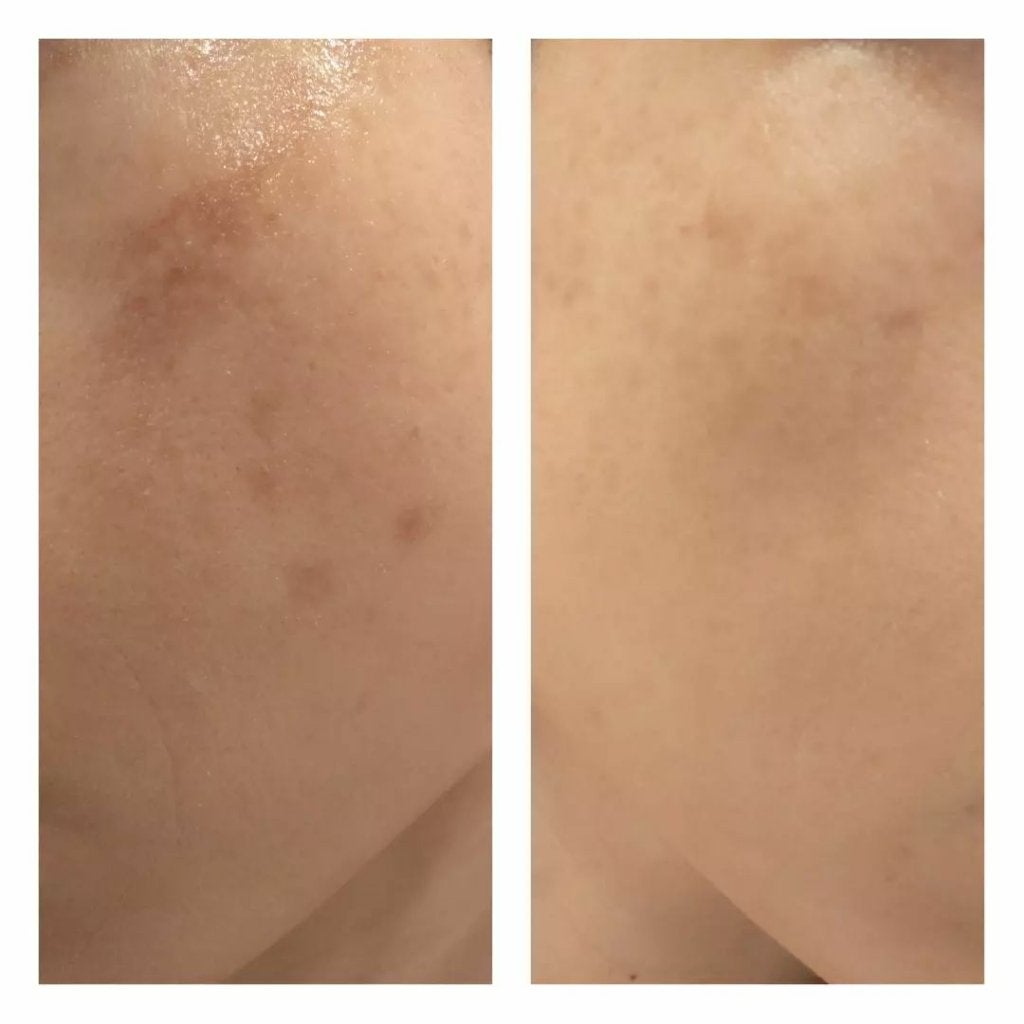 あにゃにゃ♡フォロバ100♡ on LIPS 「7回目のフォトシルクプラス後1週間の変化🙌※去年の8月から品川..」(2枚目)