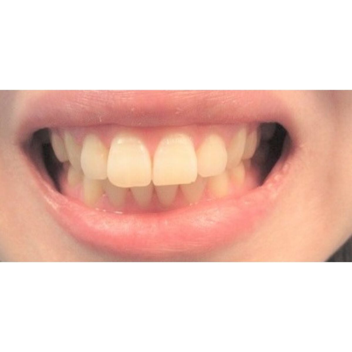 みとらん on LIPS 「さてさて、わたくし、アラフォーにして歯科矯正を始めました。今回..」(7枚目)