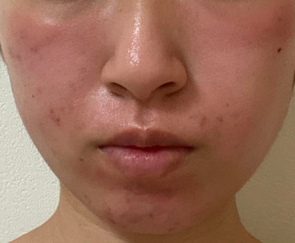 カバーパーフェクション チップコンシーラー/the SAEM/リキッドコンシーラーを使ったクチコミ(3枚目)