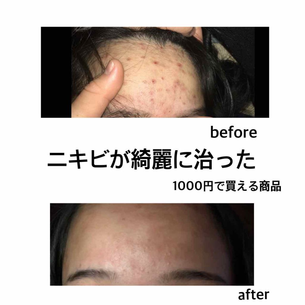 テラ コートリル 軟膏 医薬品 ジョンソン エンド ジョンソンの口コミ テラコートリル赤ニキビに使える商品 You By R 代前半 Lips