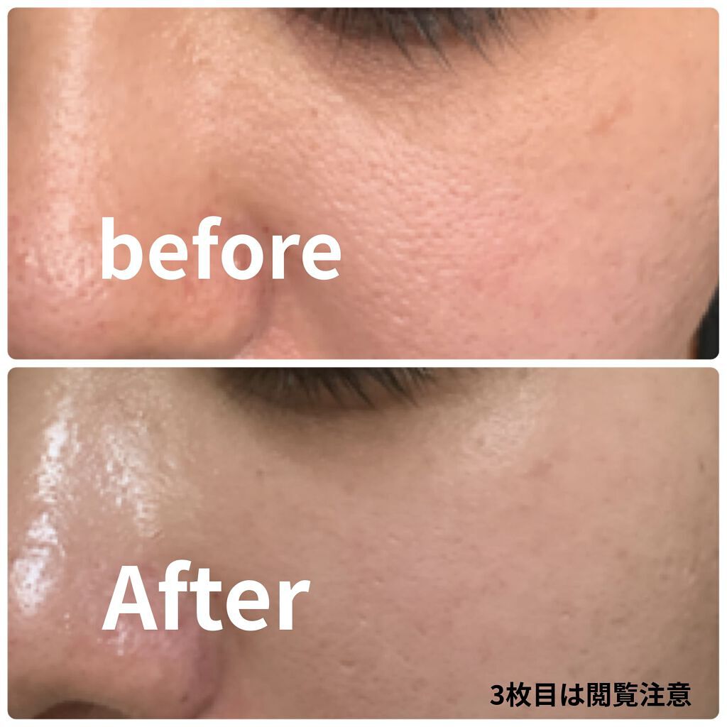 多機能温冷美顔器/ANLAN/美顔器・マッサージを使ったクチコミ（2枚目）