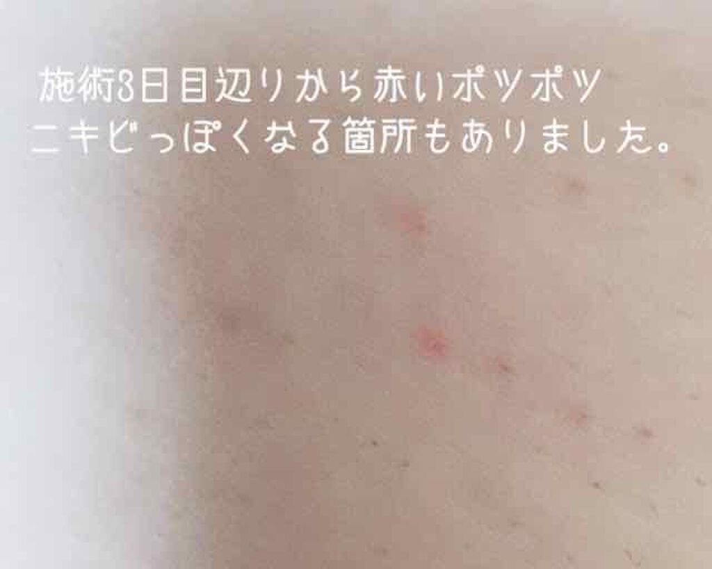 ☆scallop☆フォロバ100%☆ on LIPS 「湘南美容外科クリニック医療脱毛レポート初めて医療脱毛を受けて来..」(3枚目)