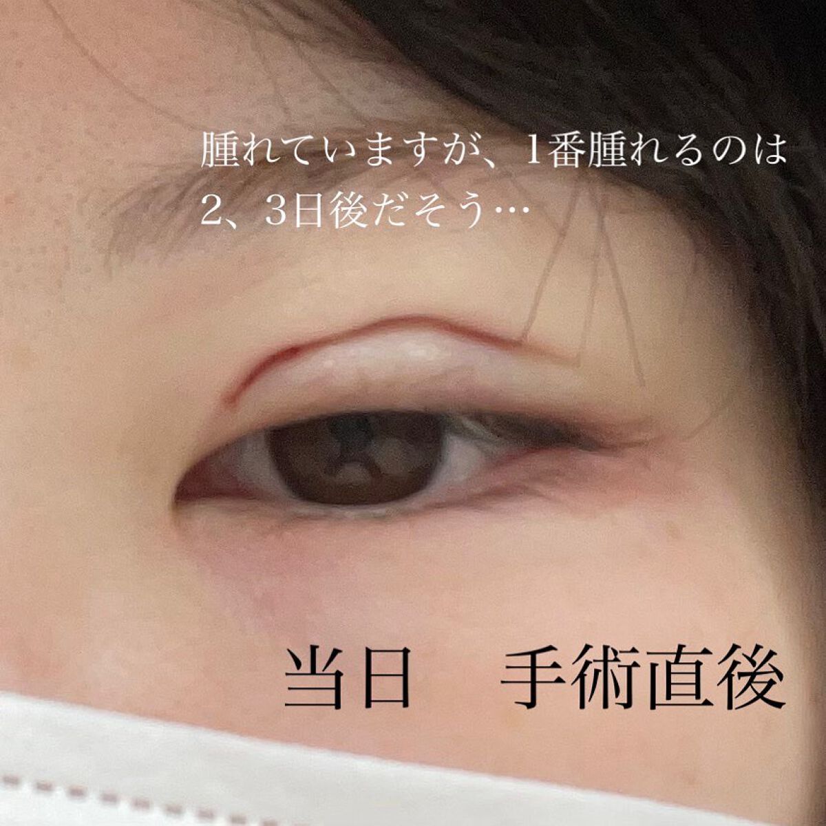 すぅ on LIPS 「私は、4年前から少しずつプチ整形も含めて、整形しています!20..」(3枚目)