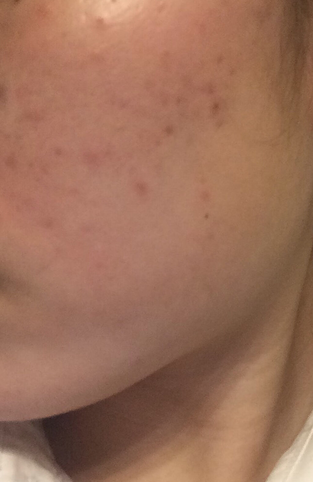 オードムーゲ 薬用ローション（ふきとり化粧水）/オードムーゲ/拭き取り化粧水を使ったクチコミ（3枚目）