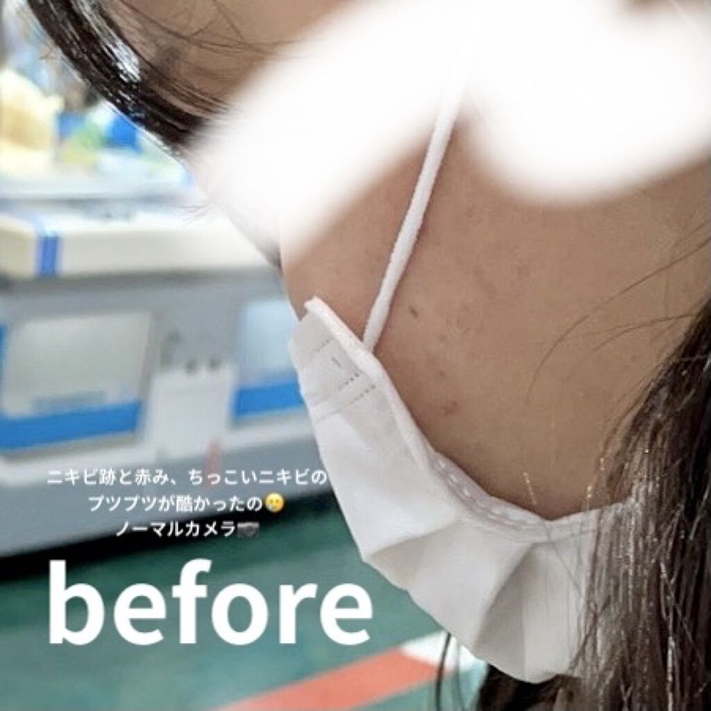 CHOI薬用マスク ニキビケア ［医薬部外品］/肌美精/シートマスク・パックを使ったクチコミ（2枚目）