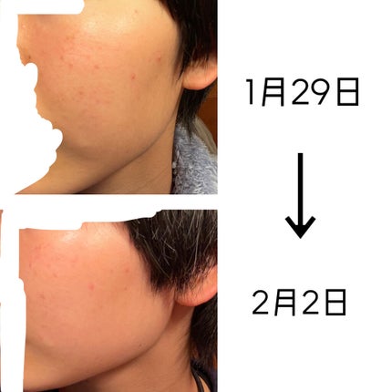 オードムーゲ 薬用ローション(ふきとり化粧水)/オードムーゲ/拭き取り化粧水を使ったクチコミ(5枚目)