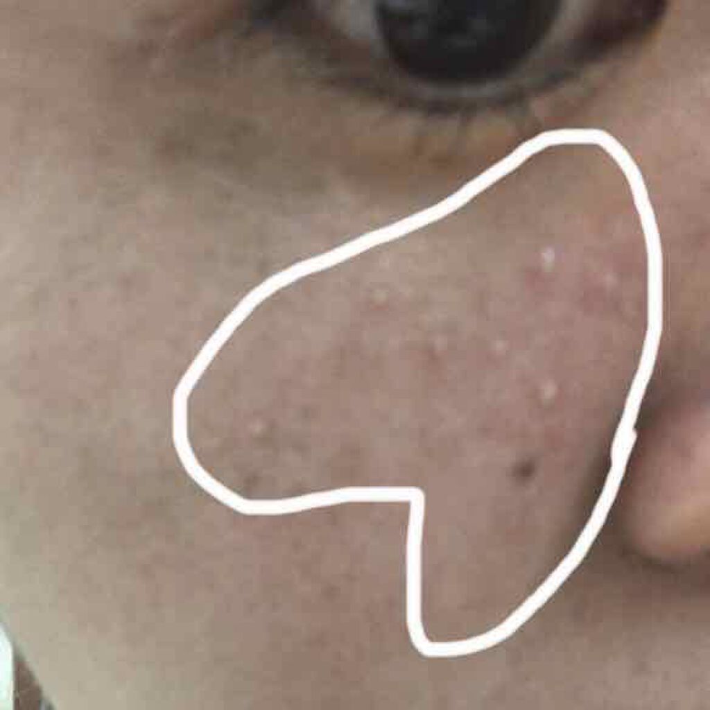 coral♡rouge on LIPS 「1年前からプツプツ出てくるこの白い物体は何だろう?と、ずっと悩..」(4枚目)