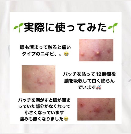 プロCICA クリアスポットパッチ/VT/その他スキンケアを使ったクチコミ(4枚目)