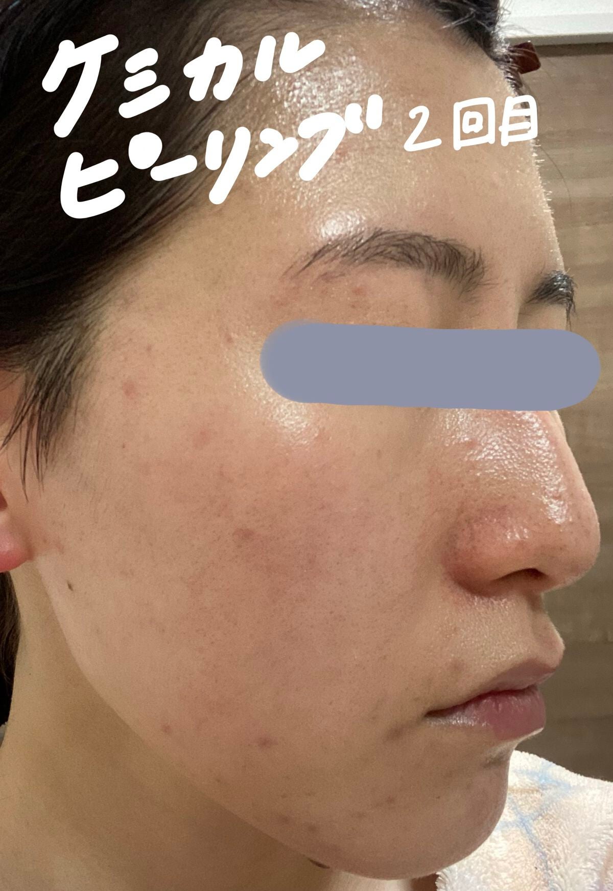 スキンピールバー ティートゥリー/サンソリット/洗顔石鹸を使ったクチコミ(2枚目)