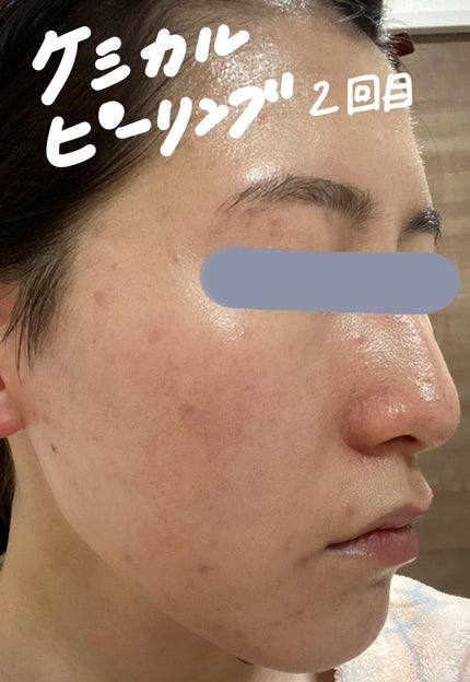 スキンピールバー ティートゥリー/サンソリット/洗顔石鹸を使ったクチコミ(2枚目)