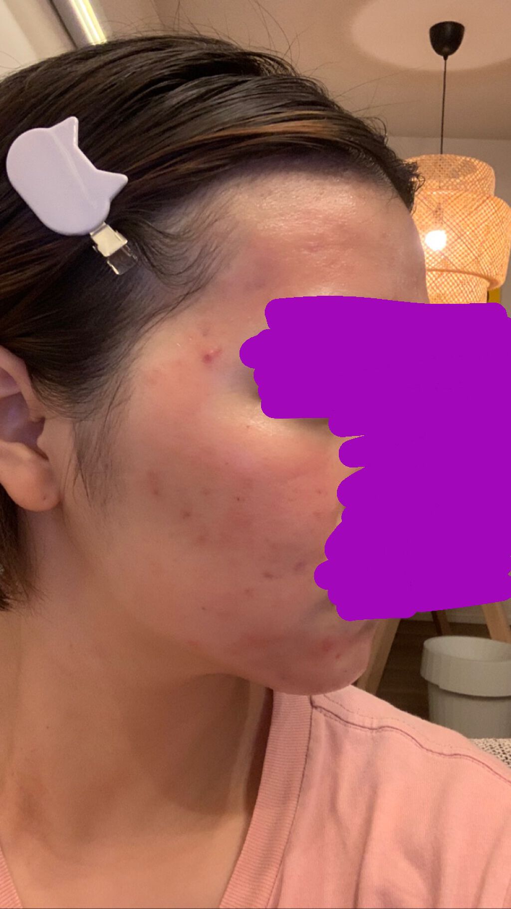 あずさ on LIPS 「エピデュオゲル7日目!かなり赤みが全体に出て乾燥しています塗っ..」(3枚目)