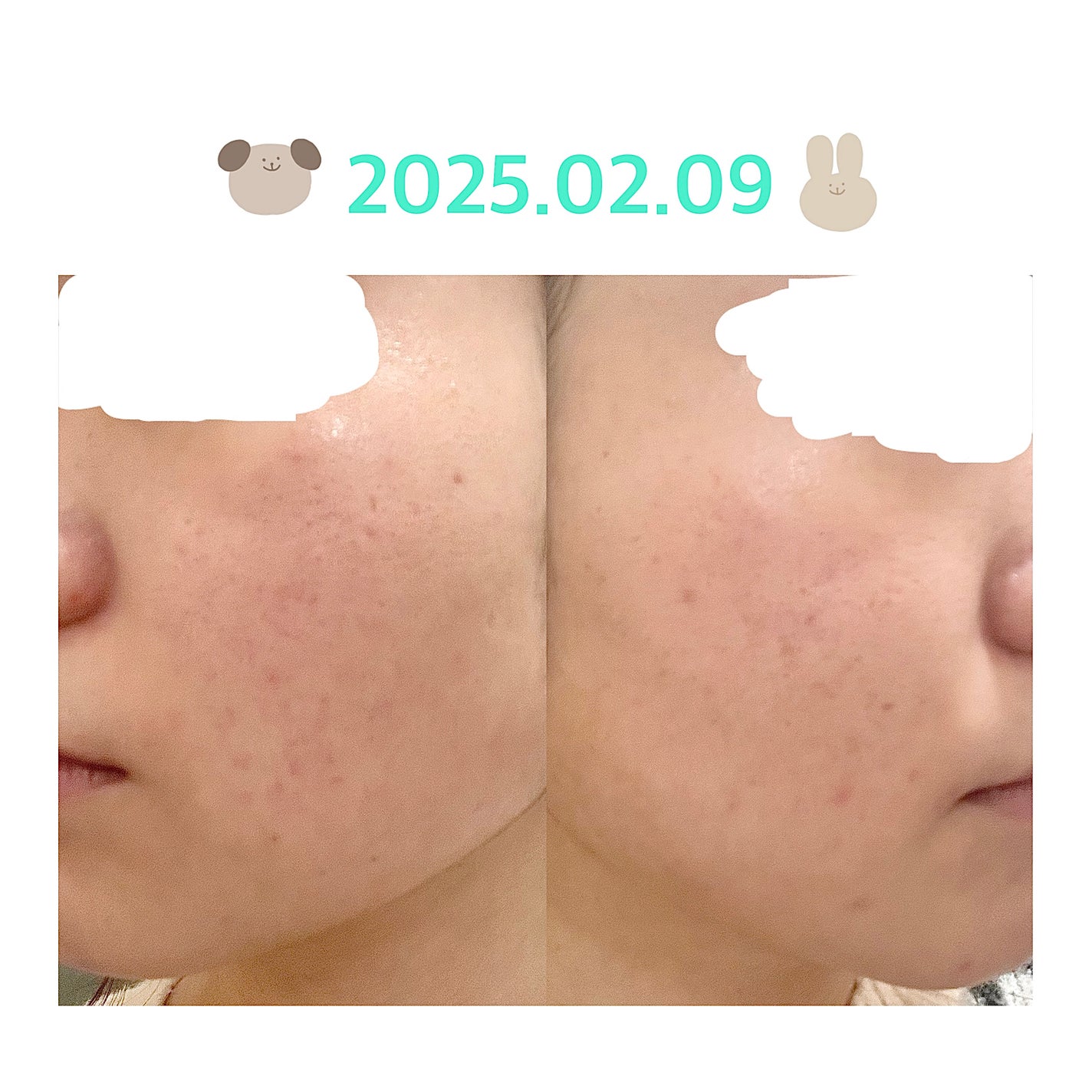 colorful_sounds_rgn on LIPS 「ニキビ経過35日目昨日の記録..」(1枚目)