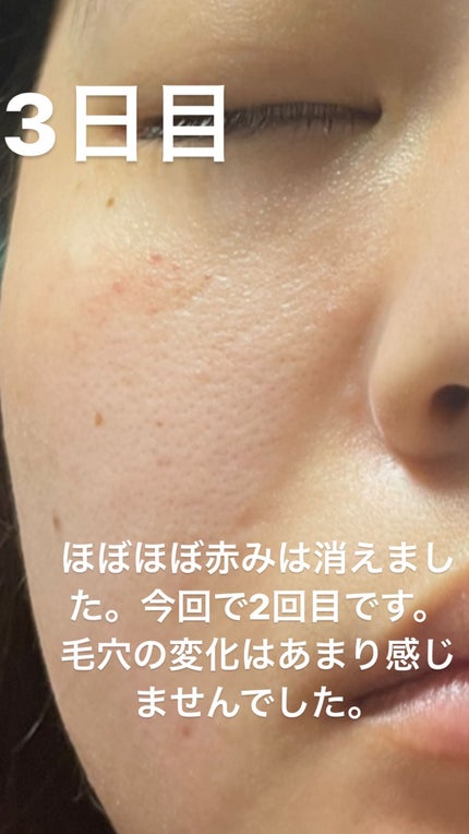 まなみ on LIPS 「ダーマペン4毛穴やクレーターなどに効く美容医療です。私は毛穴の..」(4枚目)