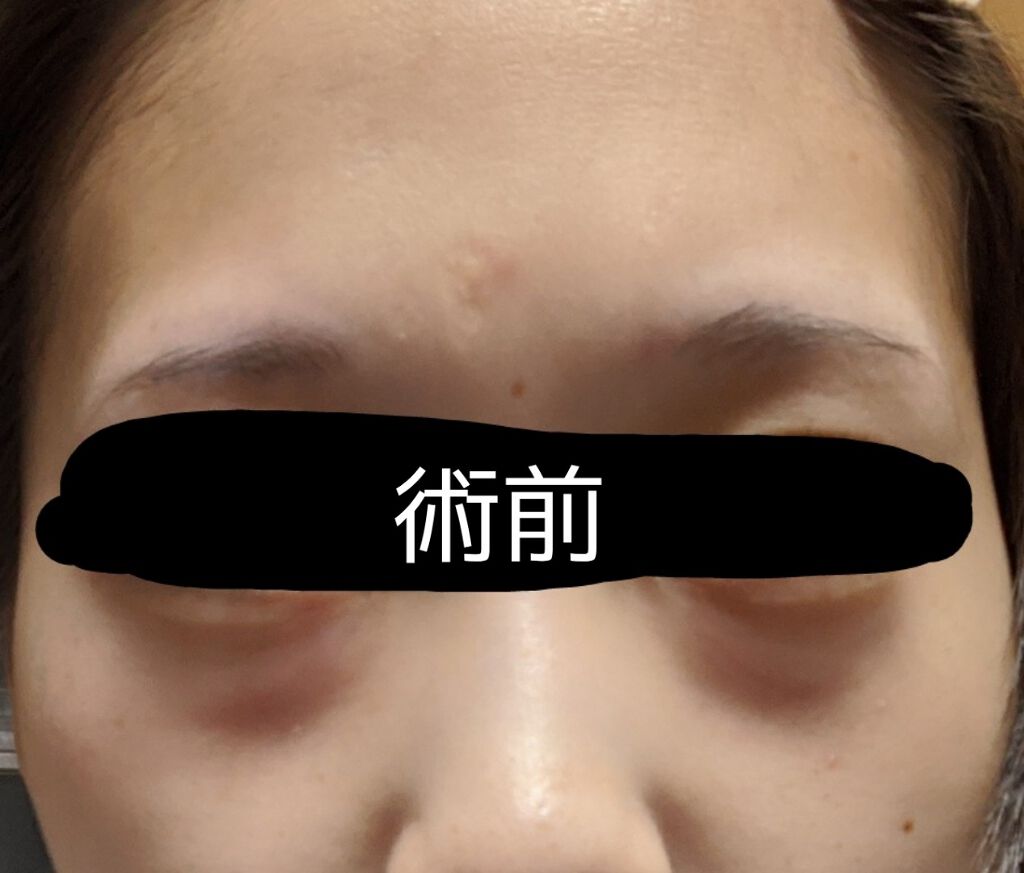 じゃりちゃん on LIPS 「湘南美容クリニックで目の下の切らないたるみ・クマ取りをしてきま..」(1枚目)