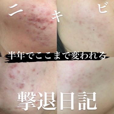 ゆるっとまるこ。 on LIPS 「🩹ニキビ撃退日記🩹vol.0実は、今までニキビとは無縁の生活を..」（1枚目）