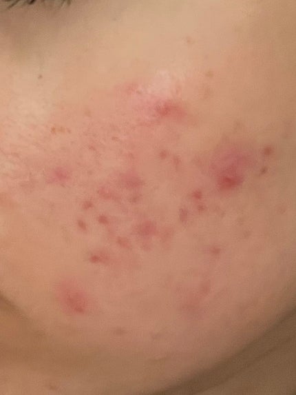 DHC DHC マルチビタミンのクチコミ「誰か助けてください……😭
どーしたらこのニキビは治りますか。
このニキビはスキンケアのみで治.....」(2枚目)