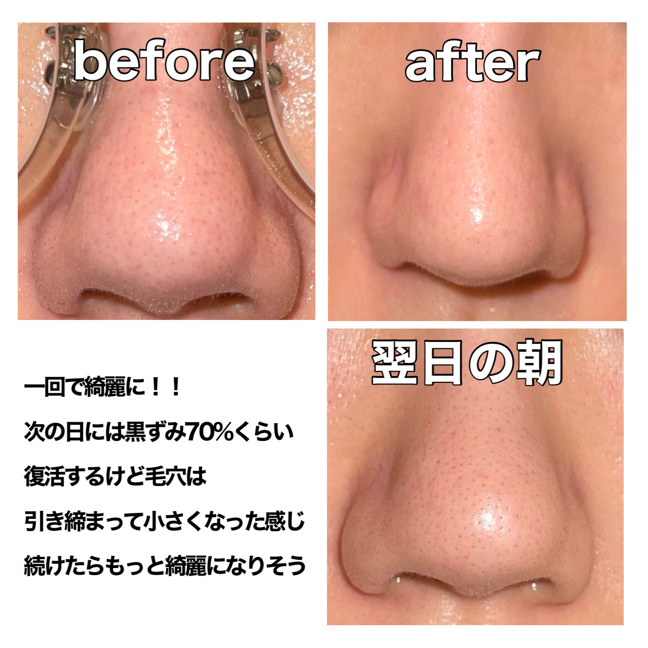 アンチポアブラックヘッドパーフェクトクリアキット/CNP Laboratory/シートマスク・パックを使ったクチコミ（2枚目）