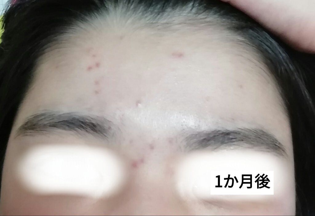 ロゼット洗顔パスタ アクネクリア/ロゼット/洗顔フォームを使ったクチコミ(3枚目)