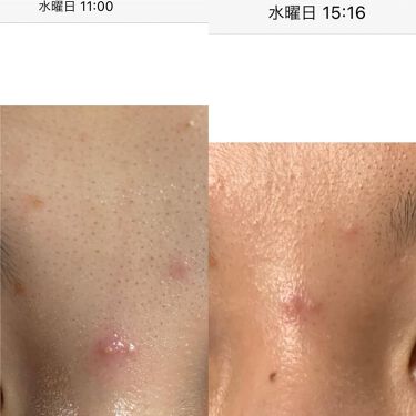 テラ コートリル 軟膏 医薬品 ジョンソン エンド ジョンソンの使い方を徹底解説 1日で効果あるニキビ対策 薬用品なの By Kuro 混合肌 代前半 Lips