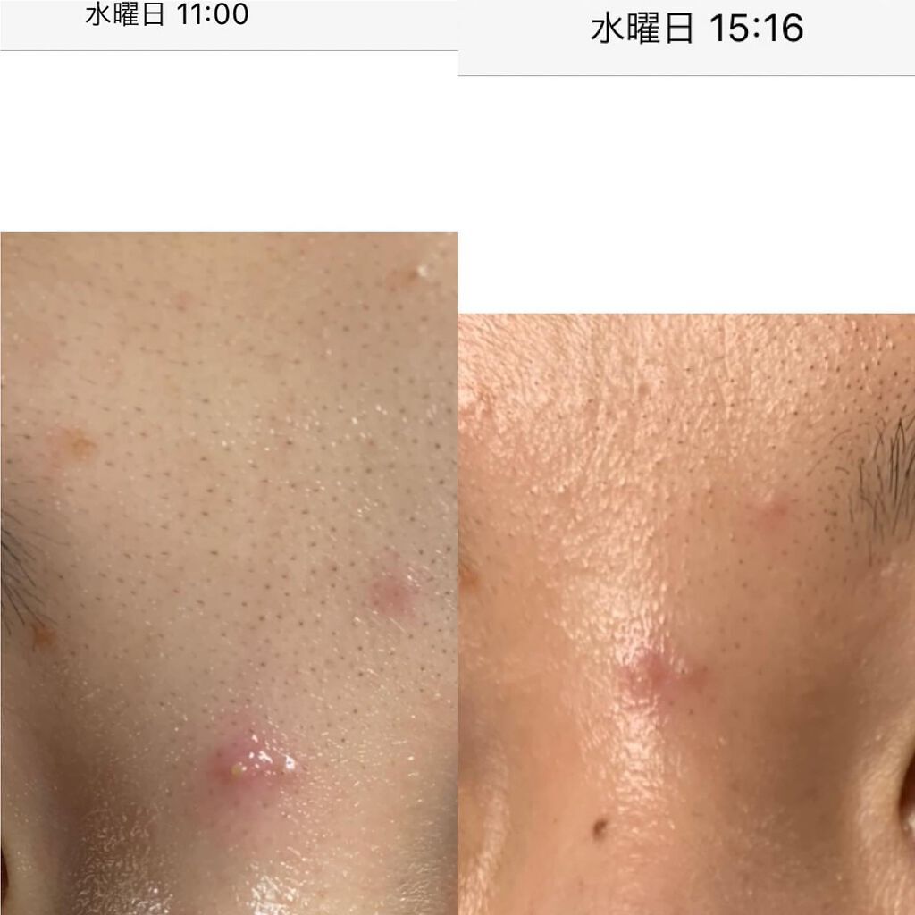 テラ コートリル 軟膏 医薬品 ジョンソン エンド ジョンソンの使い方を徹底解説 1日で効果あるニキビ対策 薬用品なの By Kuro 混合肌 代前半 Lips