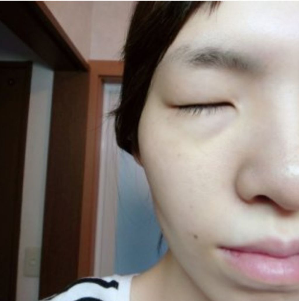 薬用 アクネケア クリアローション/DAISO/化粧水を使ったクチコミ(4枚目)