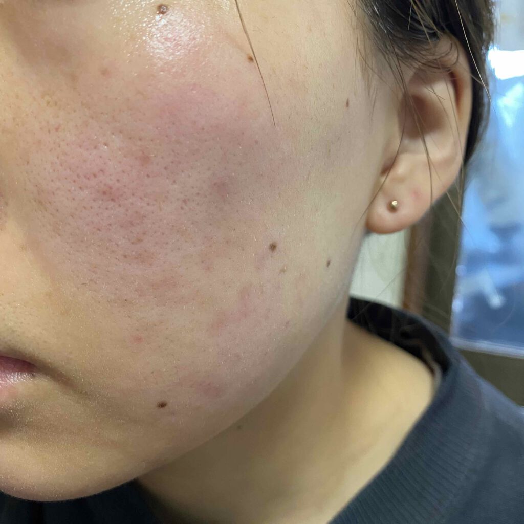 ゼビアックス(医薬品)/マルホ株式会社/その他を使ったクチコミ（2枚目）