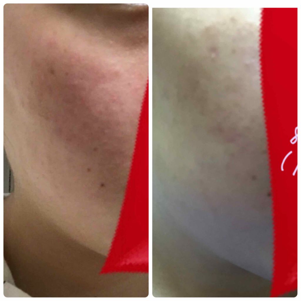 薬用 しみ 集中対策 美容液/メラノCC/美容液を使ったクチコミ（3枚目）