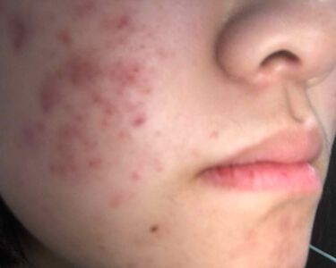 22年最新 ニキビケア 高校生特集 口コミで人気の37アイテムを紹介 Lips 22年最新 ニキビケア 高校生特集 口コミで人気の37アイテムを紹介 Lips