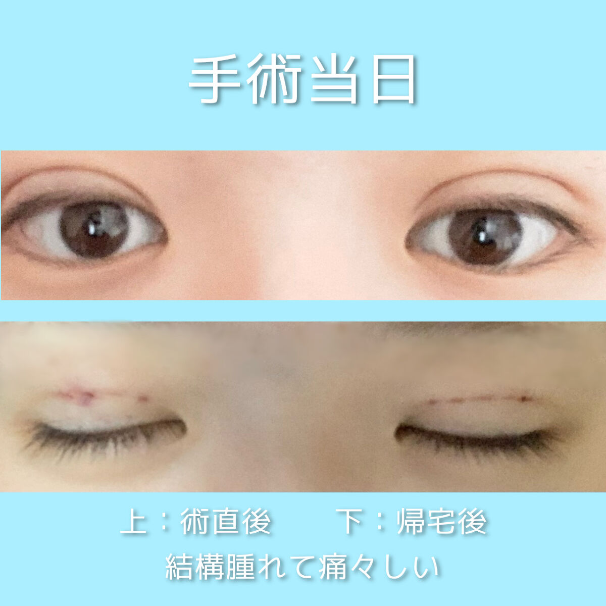 二重整形/その他を使ったクチコミ（2枚目）